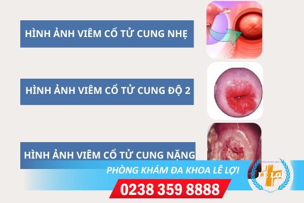 Hình ảnh viêm cổ tử cung từ nhẹ đến nặng