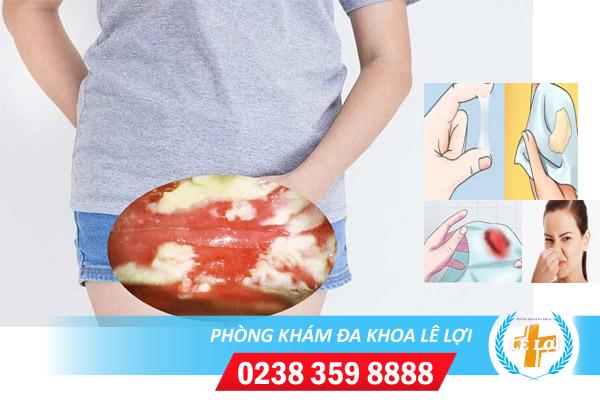 Dấu hiệu nấm âm đạo nặng và cách điều trị