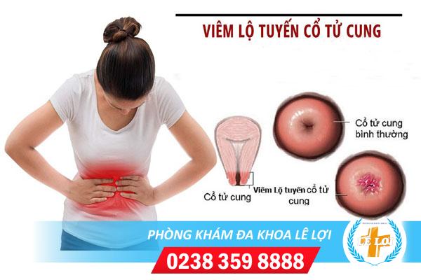 Giải đáp chi phí điều trị viêm lộ tuyến cổ tử cung