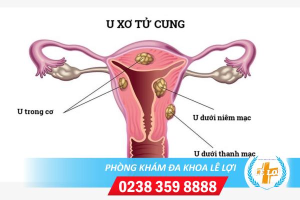 u-xo-tu-cung-gay-dau-bung-duoi