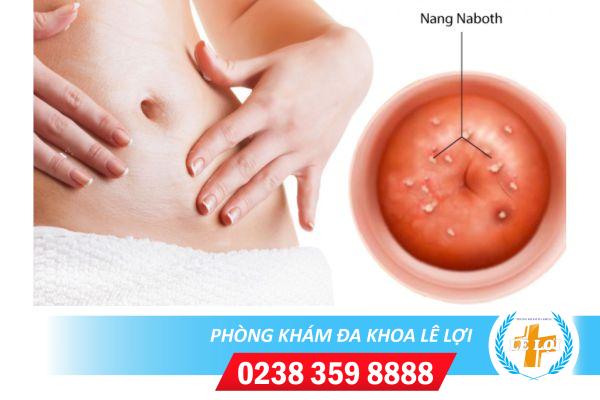 Nang Naboth Cổ Tử Cung Do Đâu Và Phương Pháp Điều Trị Hiệu Quả